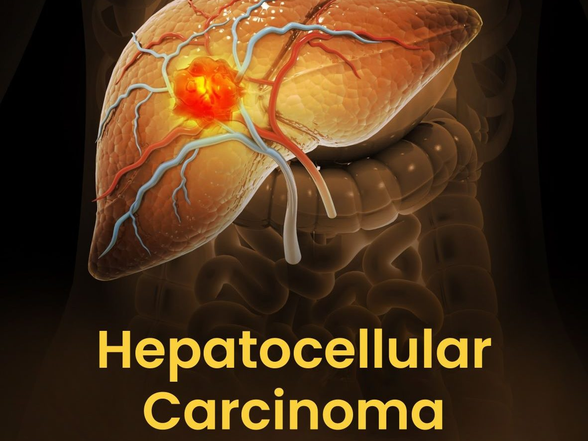 Atezolizumab Plus Bevacizumab