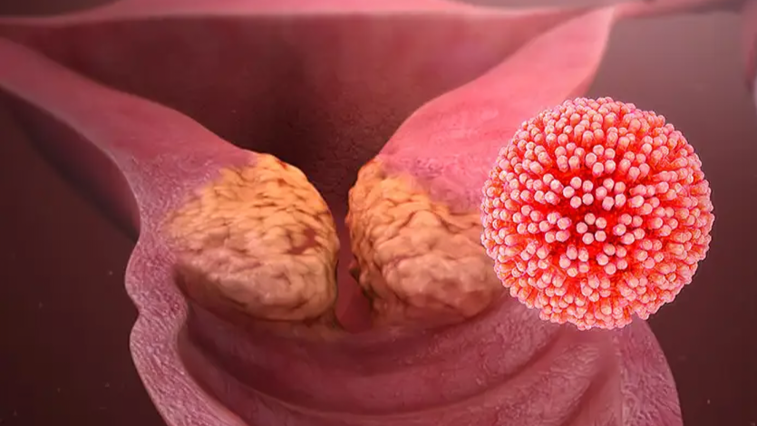 Cervical cancer