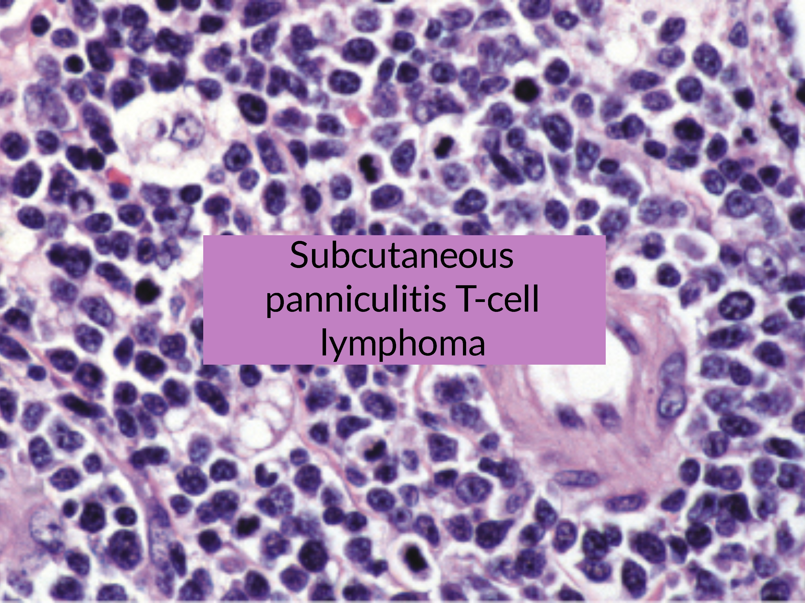 panniculitis T-cell lymphoma
