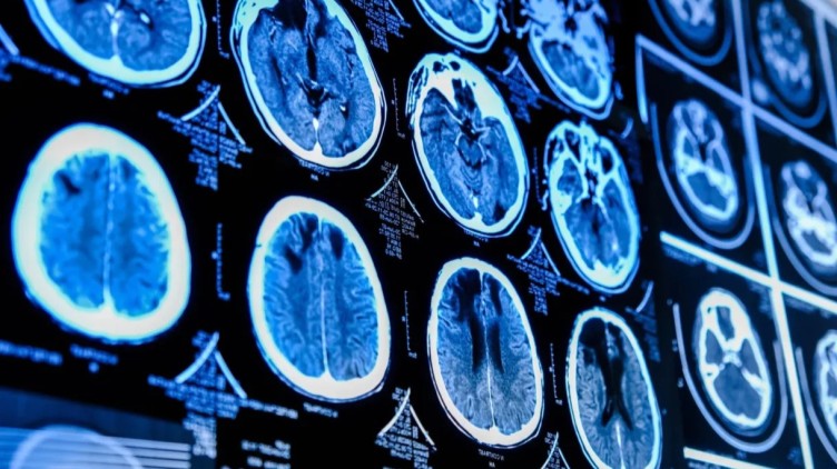 brain cancer