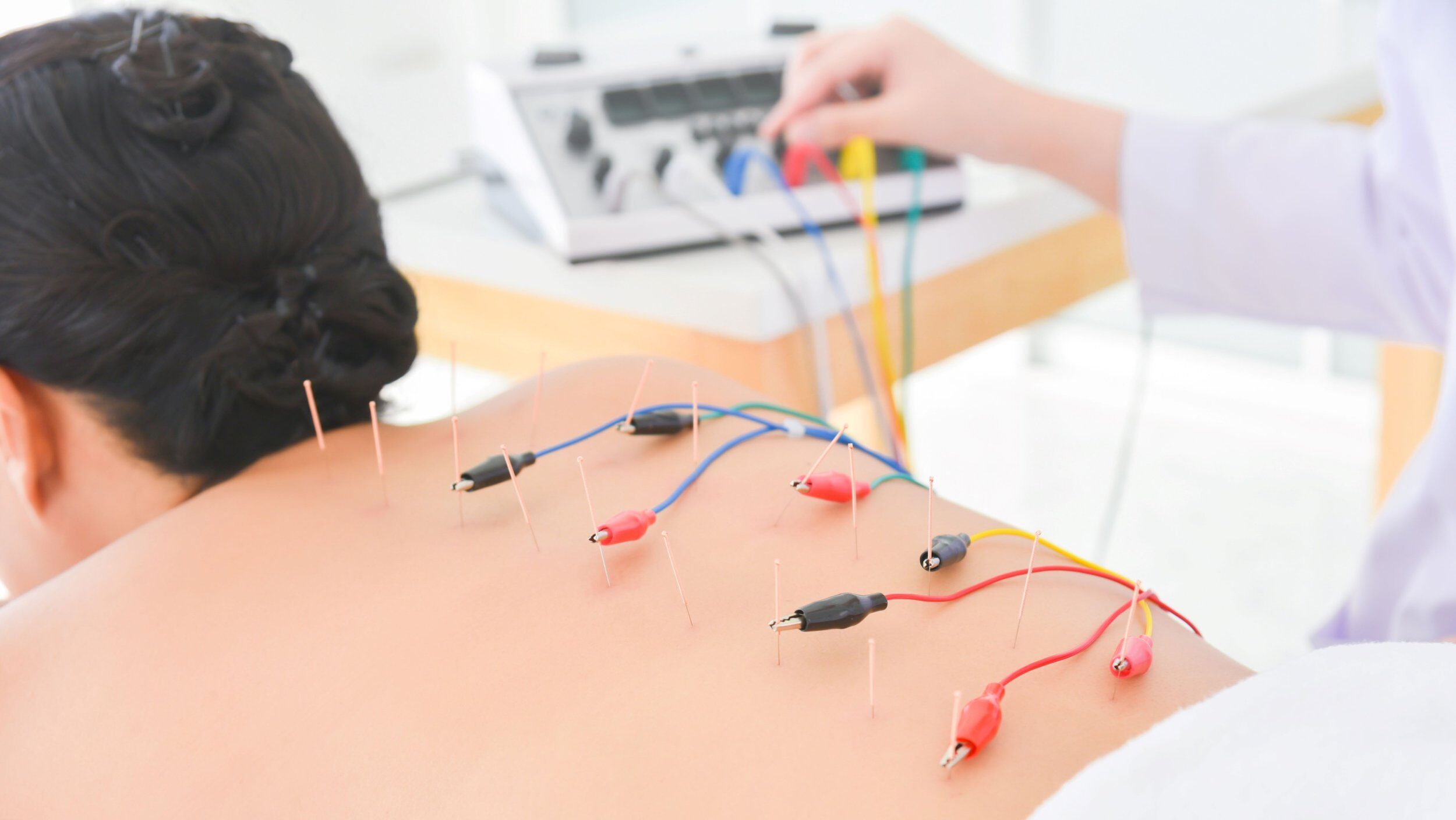 electroacupuncture
