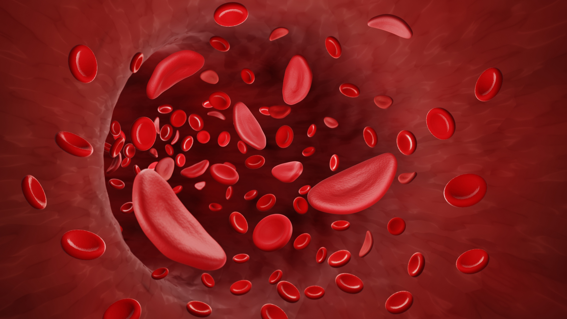 sickle cell