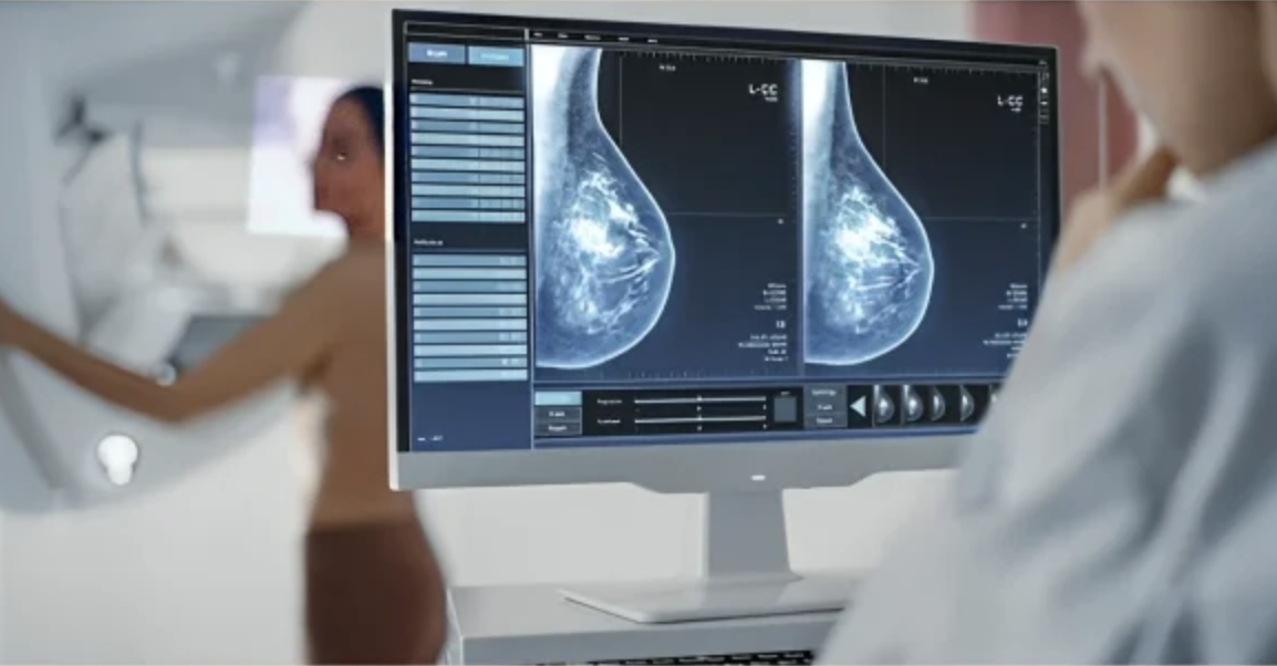 Explore breast cancer statistics on IARC's Global Cancer Observatory - IARC/WHO