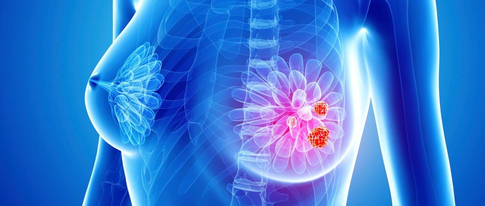 breast cancer
