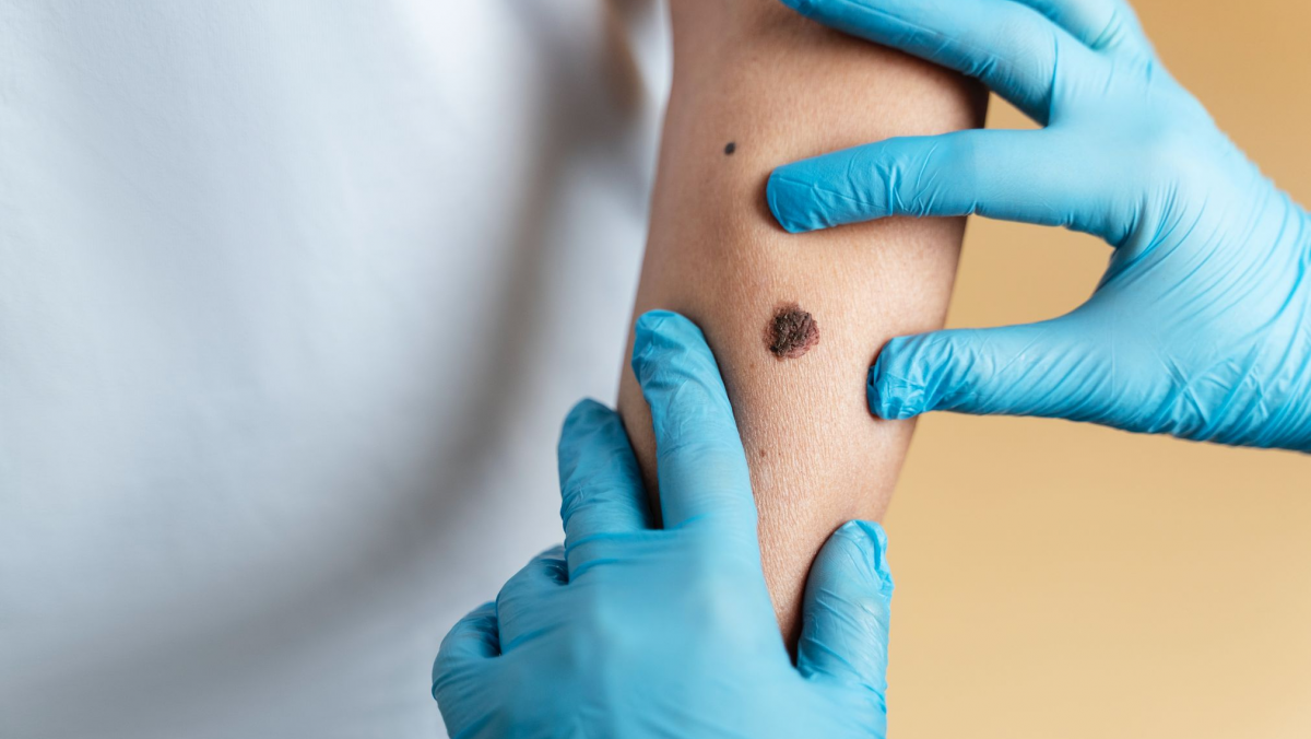 melanoma