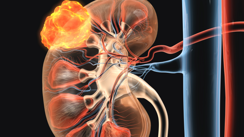 Renal Cell Carcinoma Sites