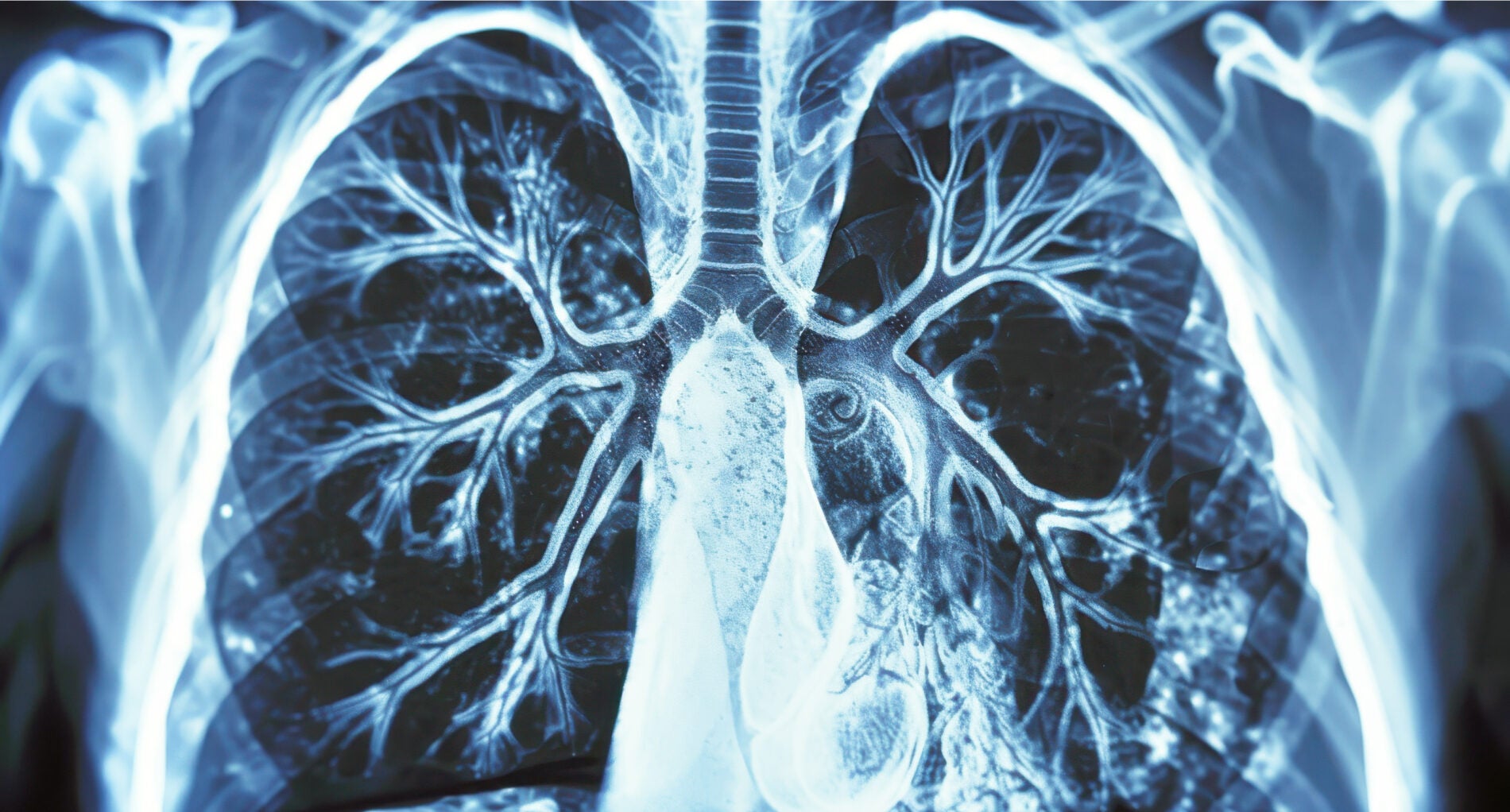 lung cancer