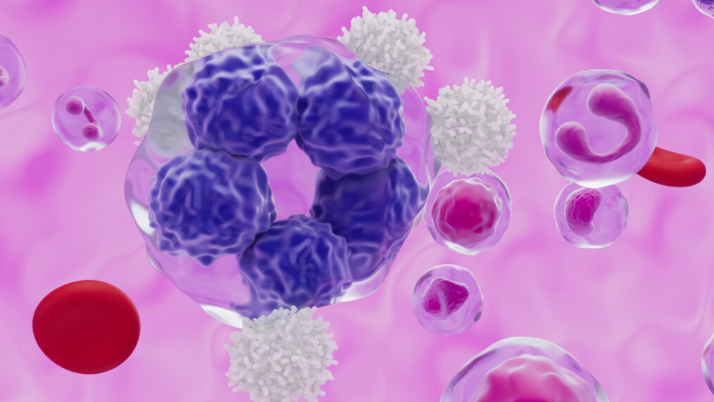 Large B-Cell Lymphoma