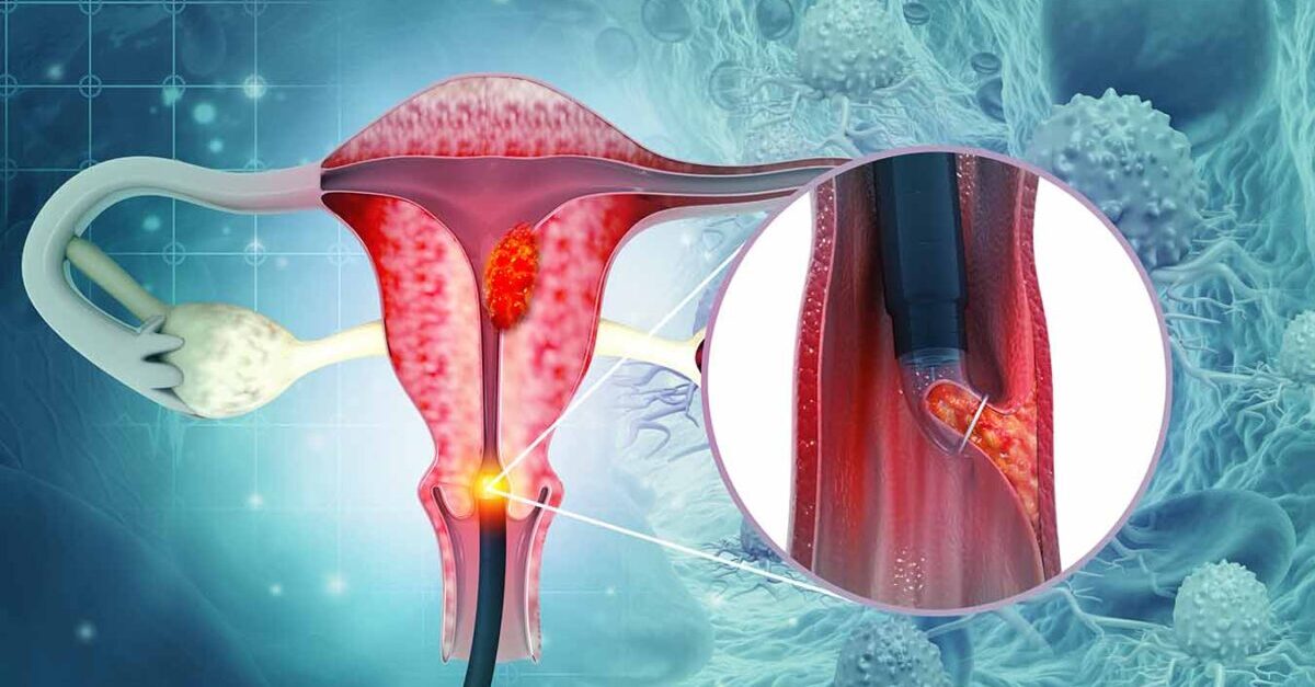 Endometrial cancer
