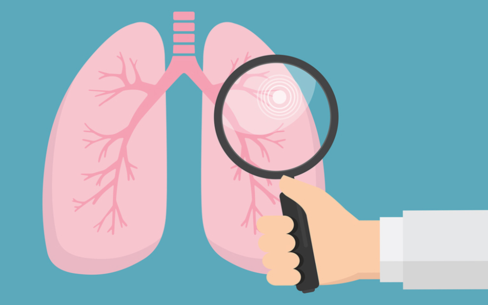 lung cancer