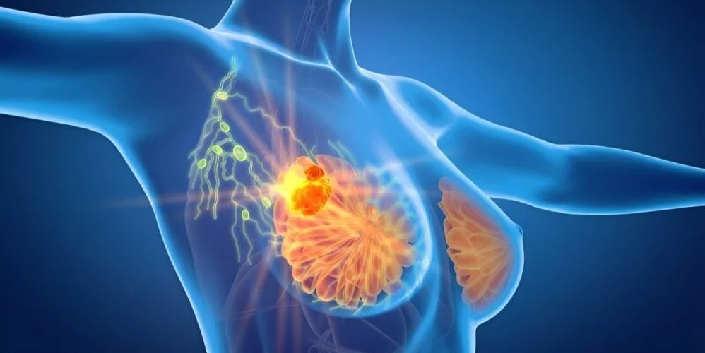 Breast Cancer Network Australia