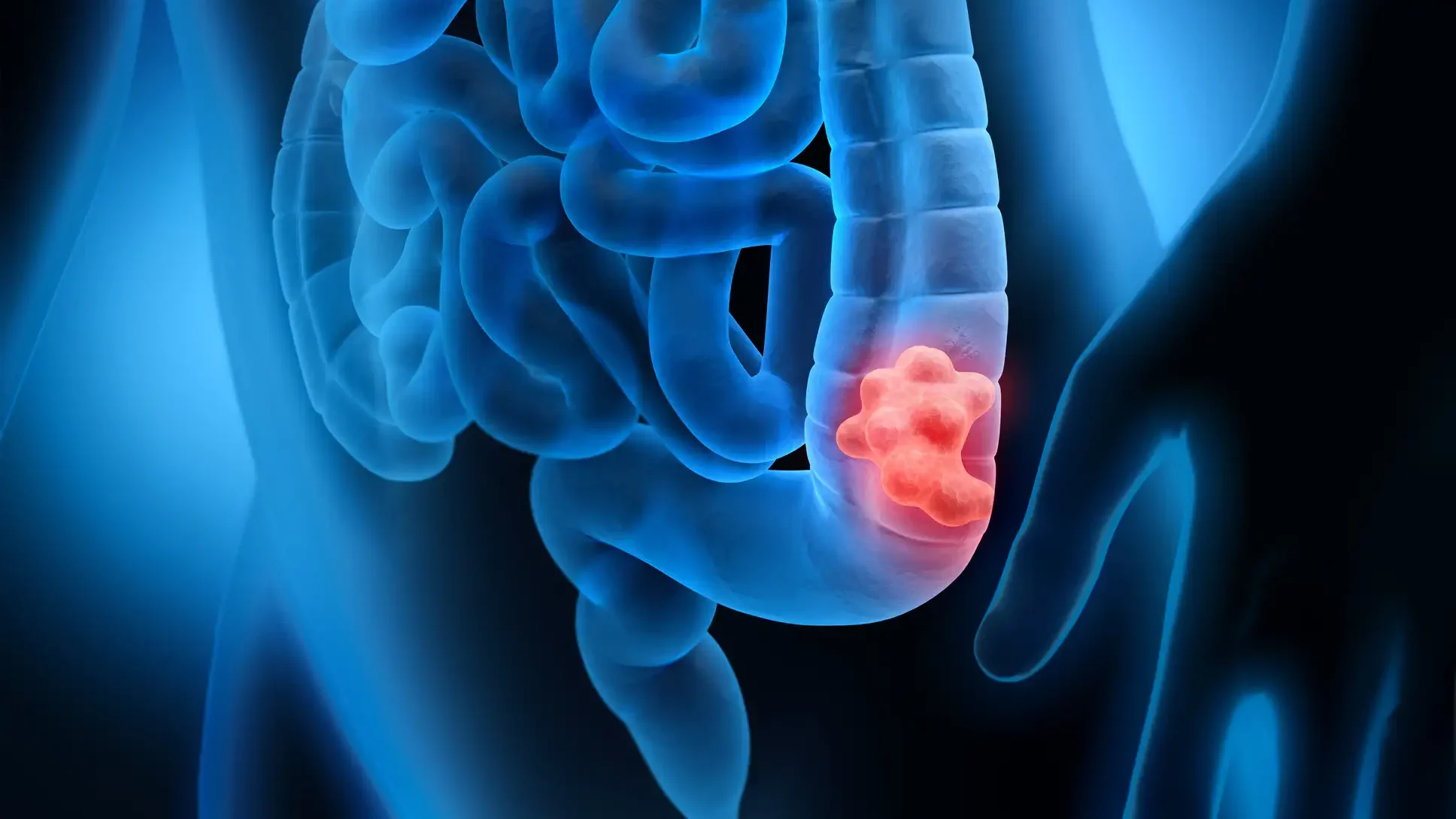 Colorectal Cancer