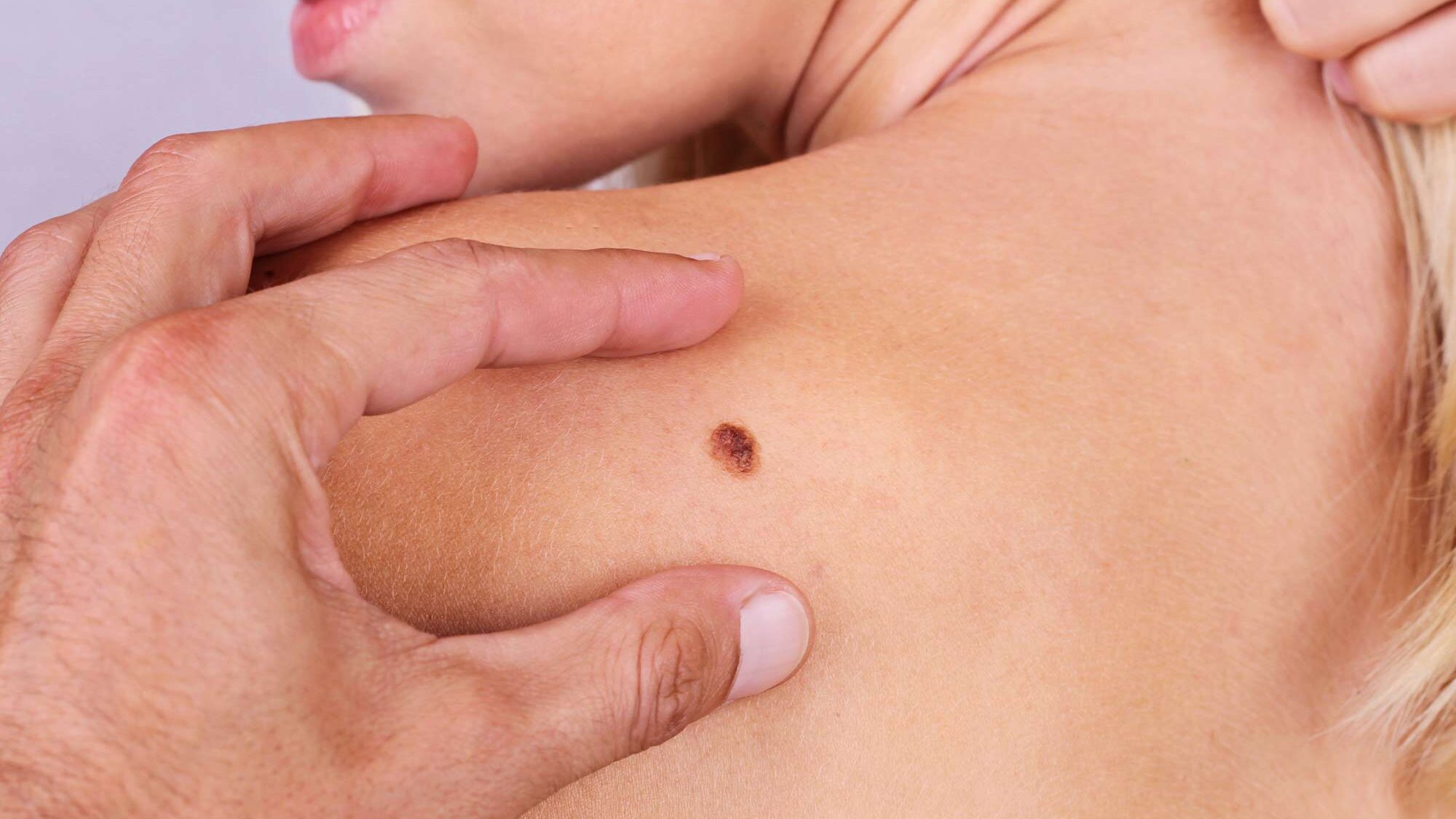 Three-Year Overall Survival with Nivolumab + Relatlimab rela-nivo in Advanced Melanoma