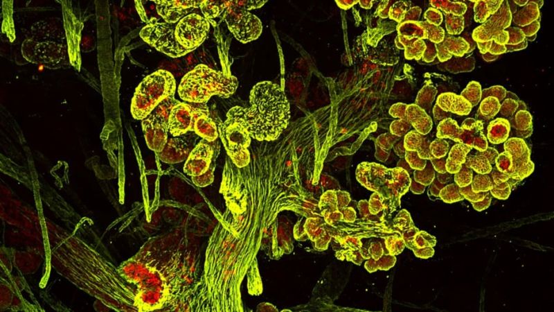 Overcoming recurrence: How research is bringing new hope for breast cancer patients - The Institute of Cancer Research