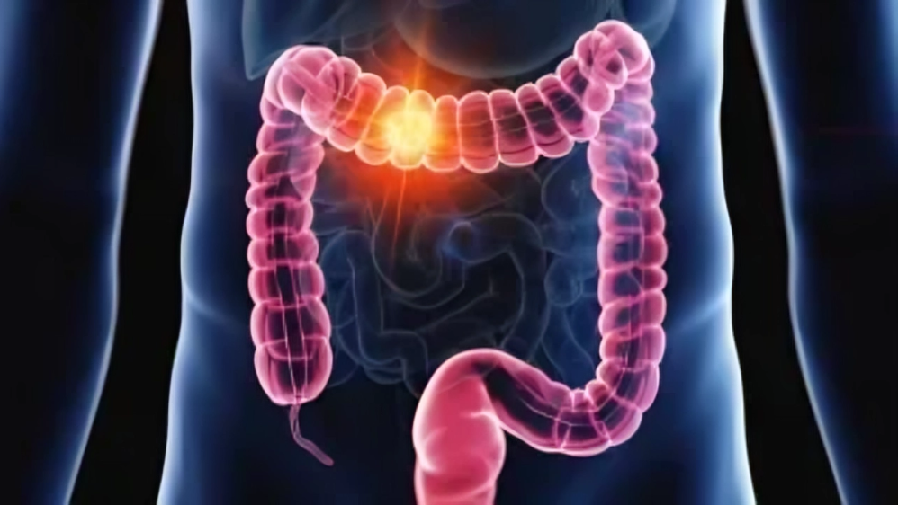 Colon Cancer