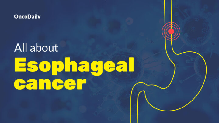 esophageal cancer