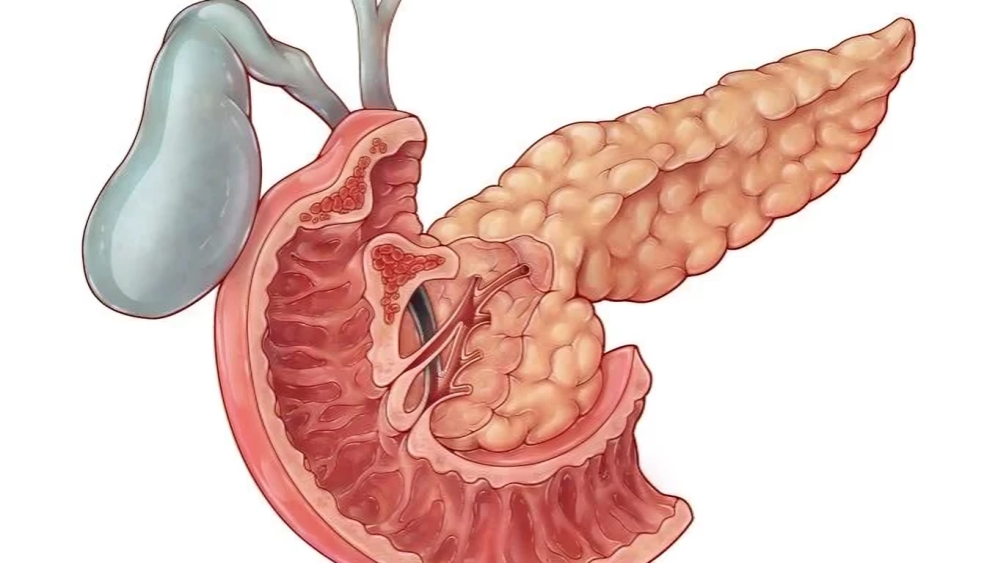 ampullary carcinoma