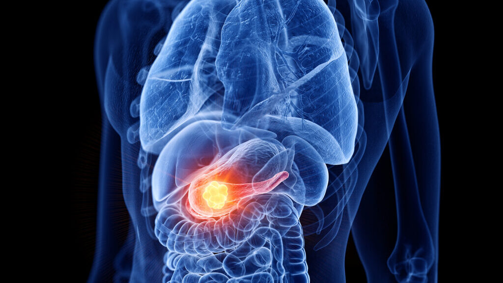 Pancreatic Cancer