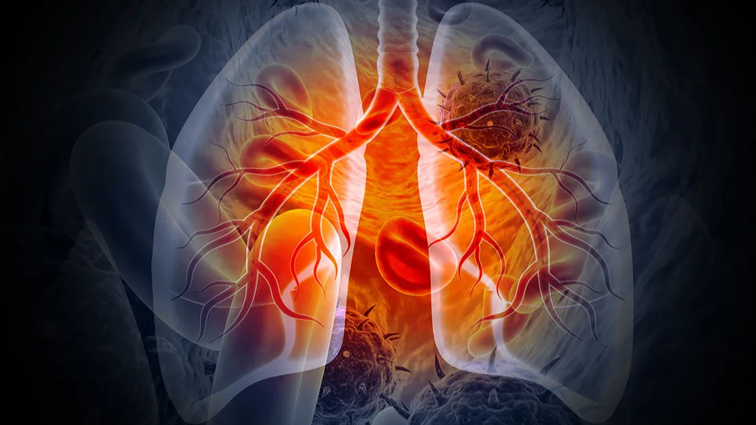 Bruce Dunbar: Lung cancer is still the number 1 cancer killer