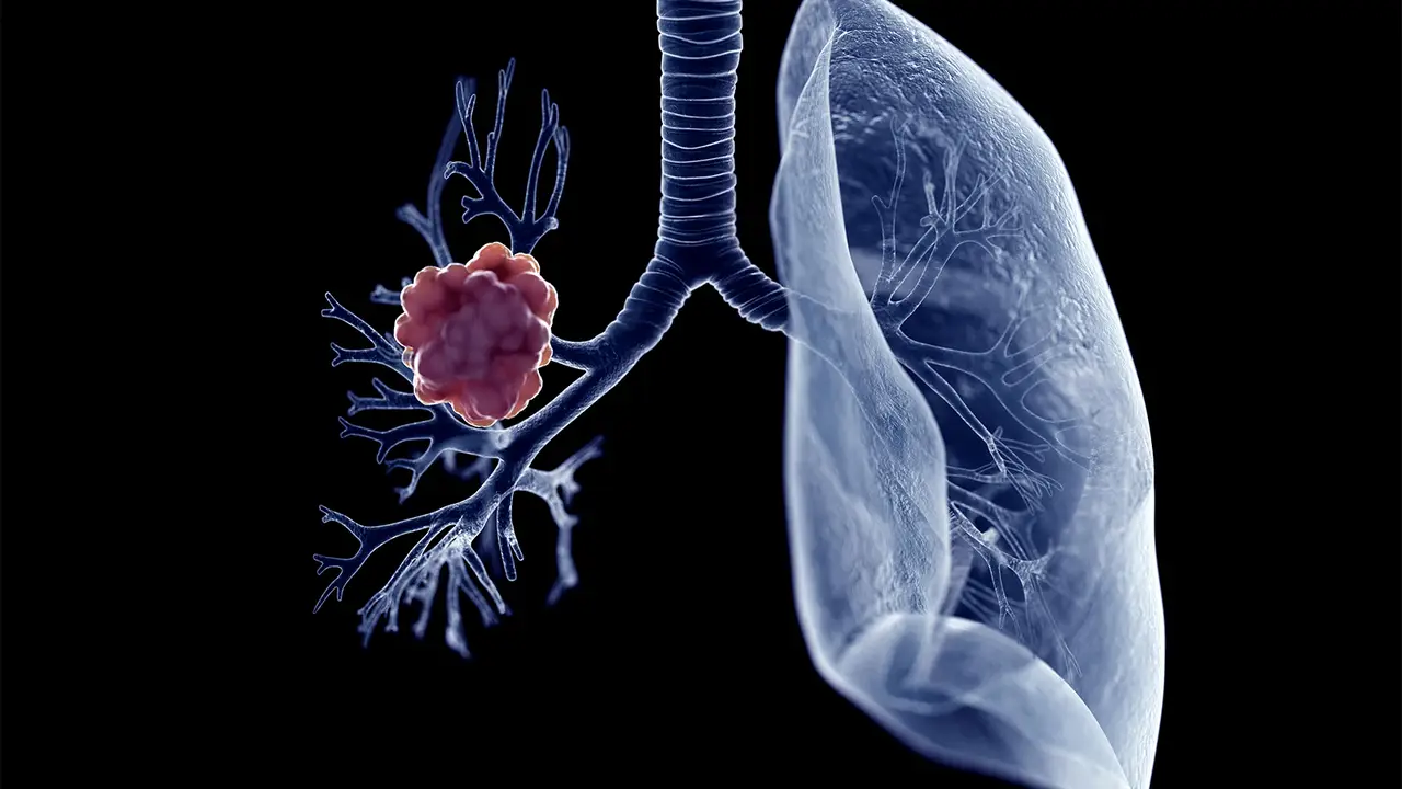 NSCLC