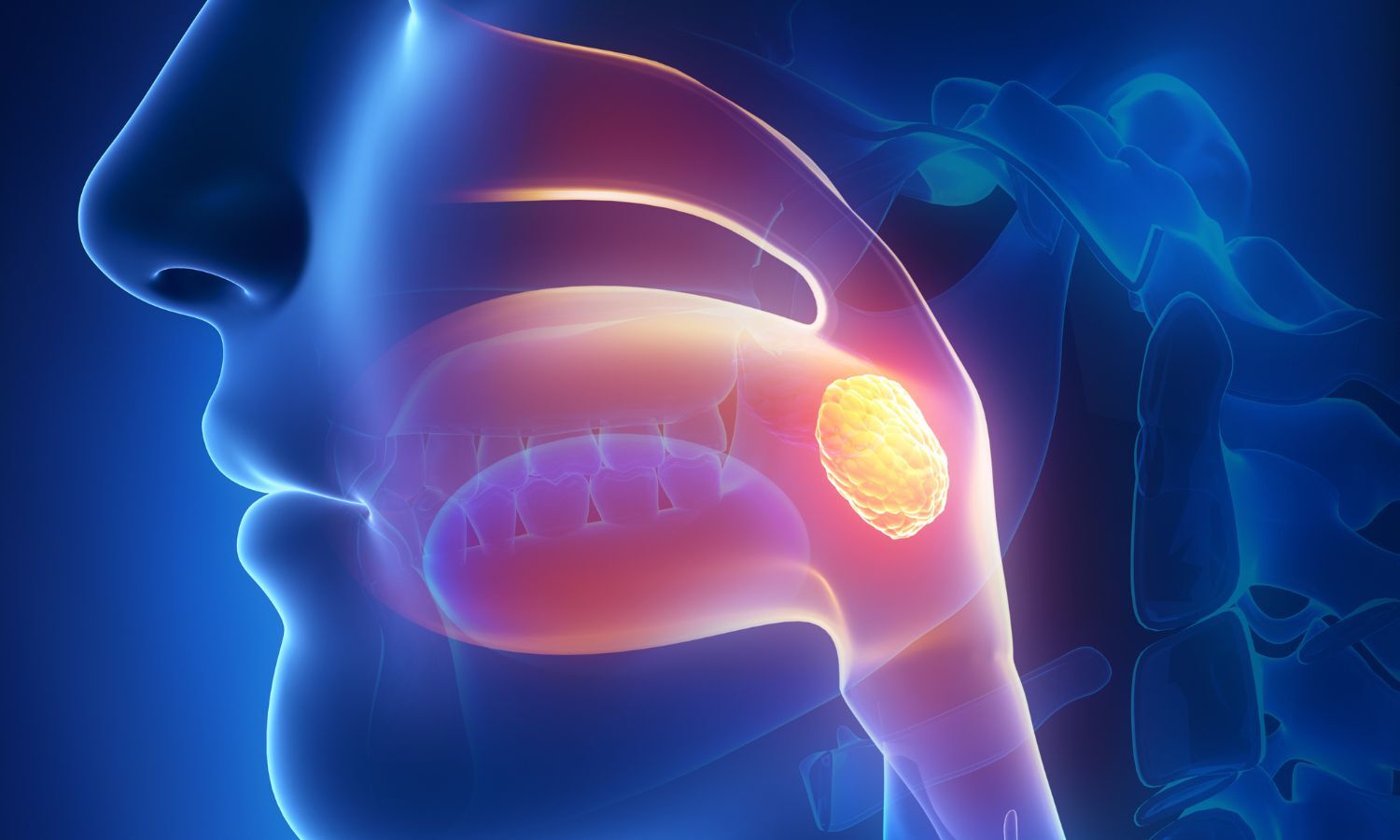 Nasopharyngeal Carcinoma