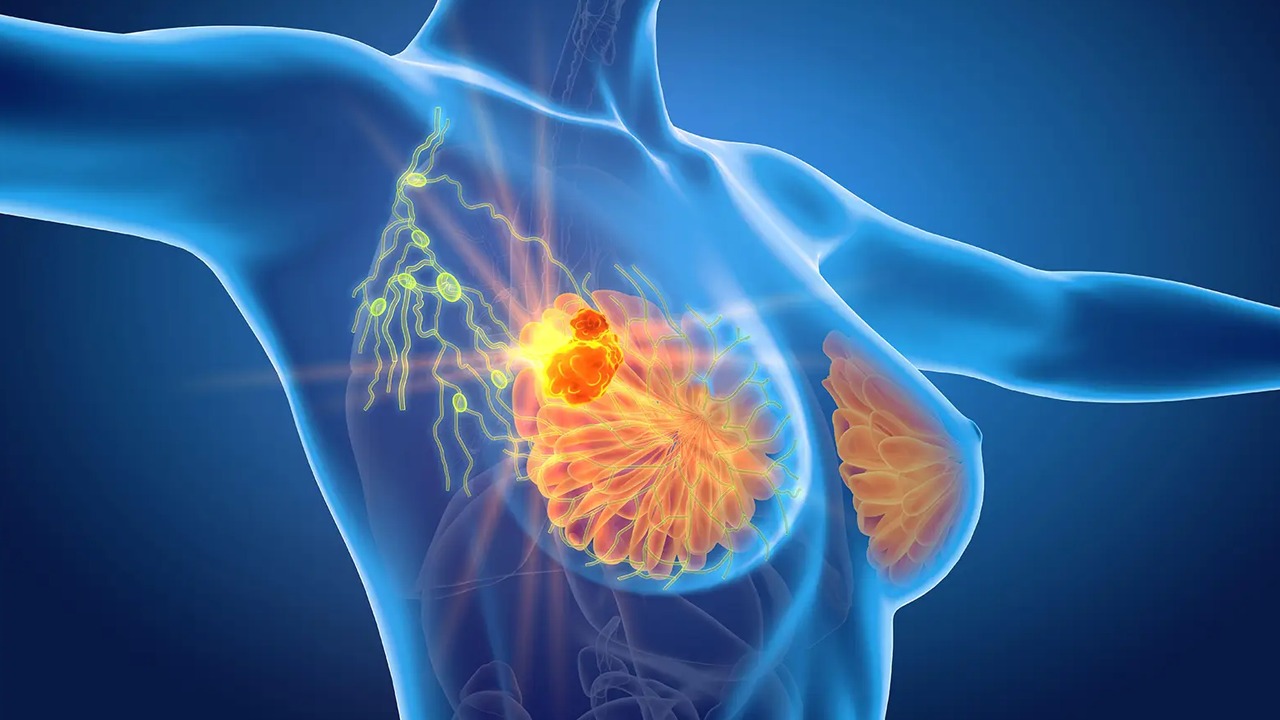 Breast Cancer