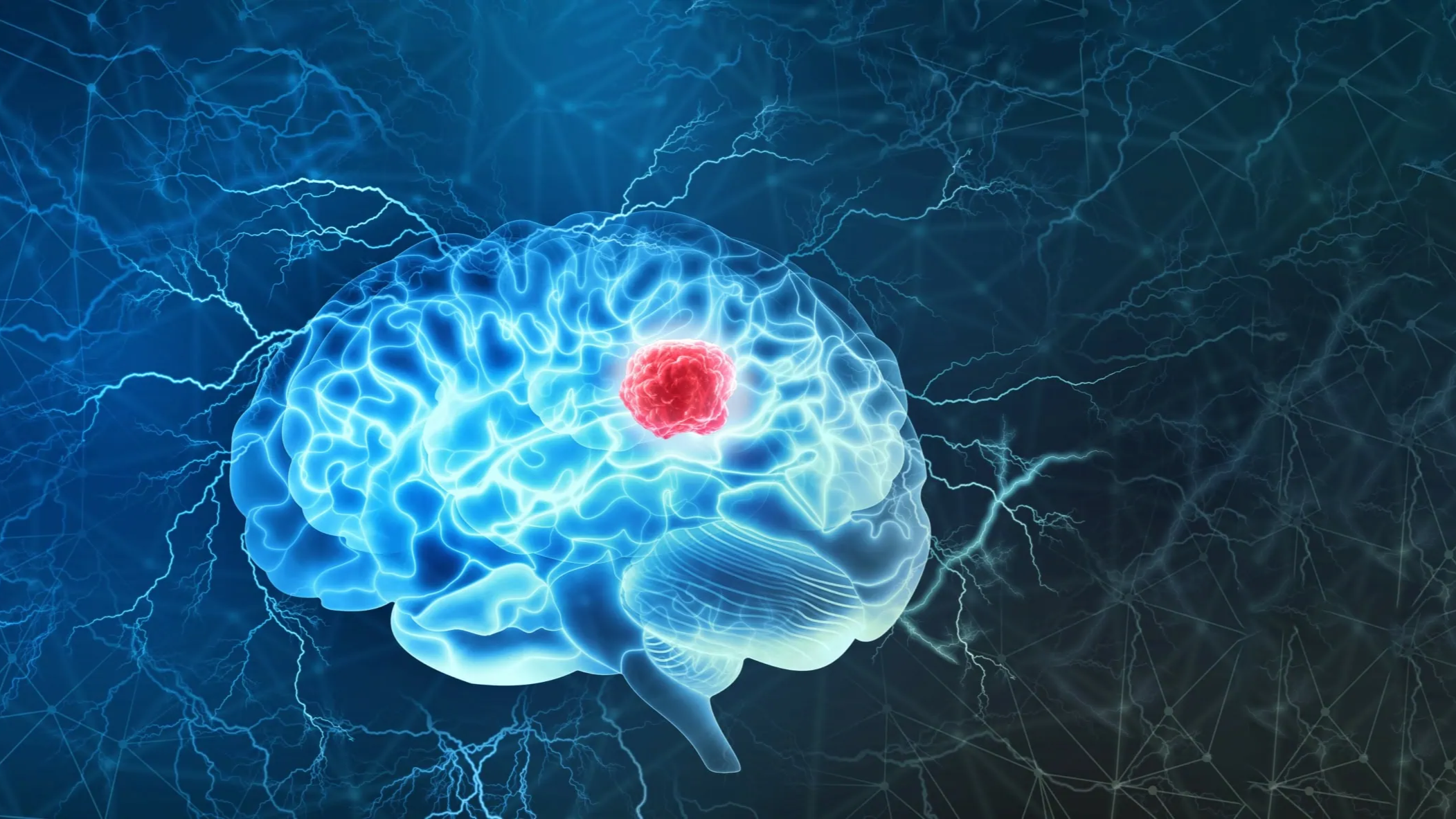 Reirradiation of glioblastoma