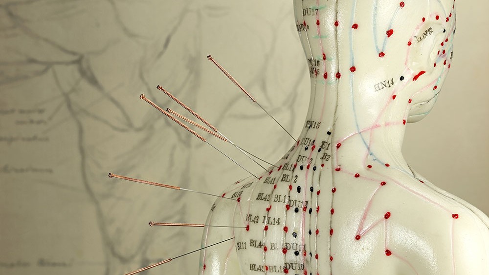 acupuncture