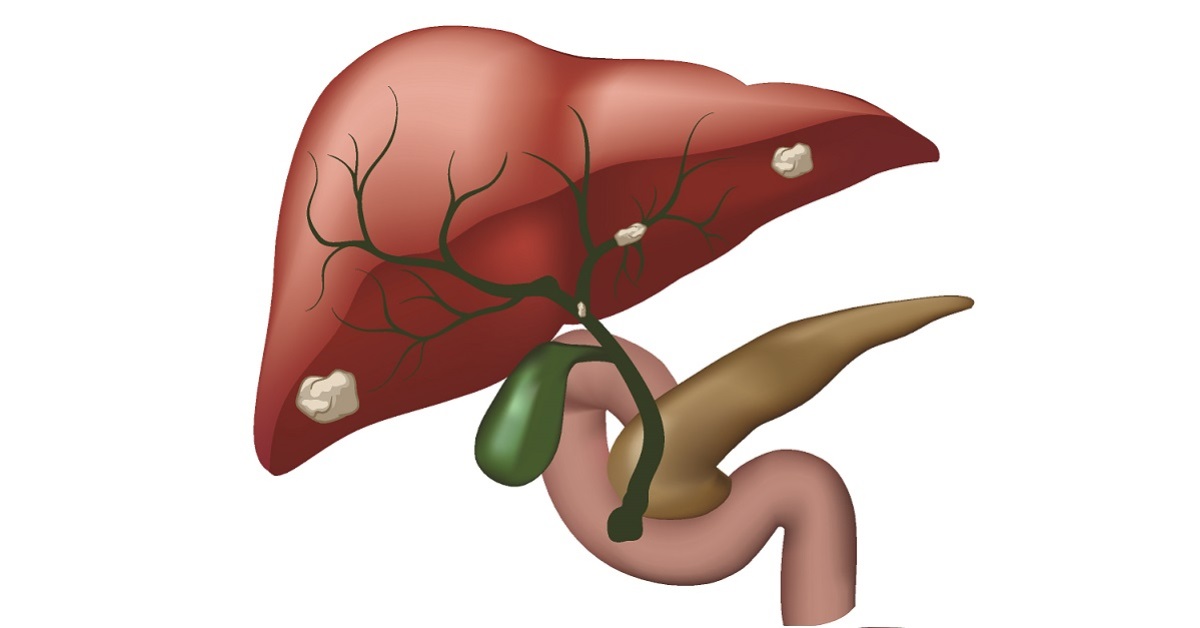 Cholangiocarcinoma