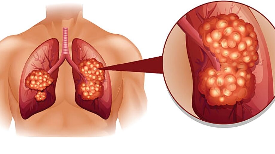 Detecting lung cancer