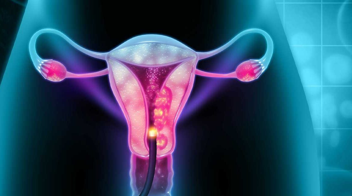 cervical cancer