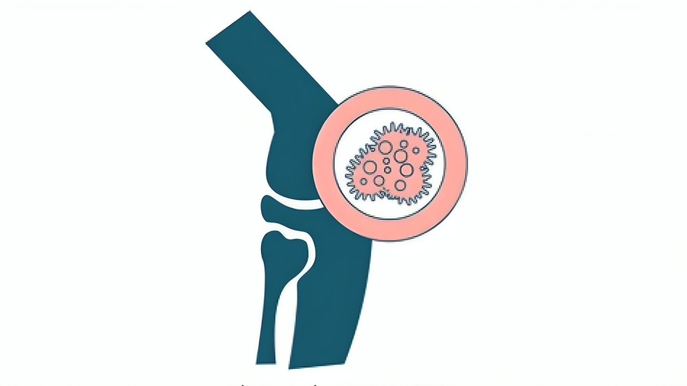 Synovial Sarcoma