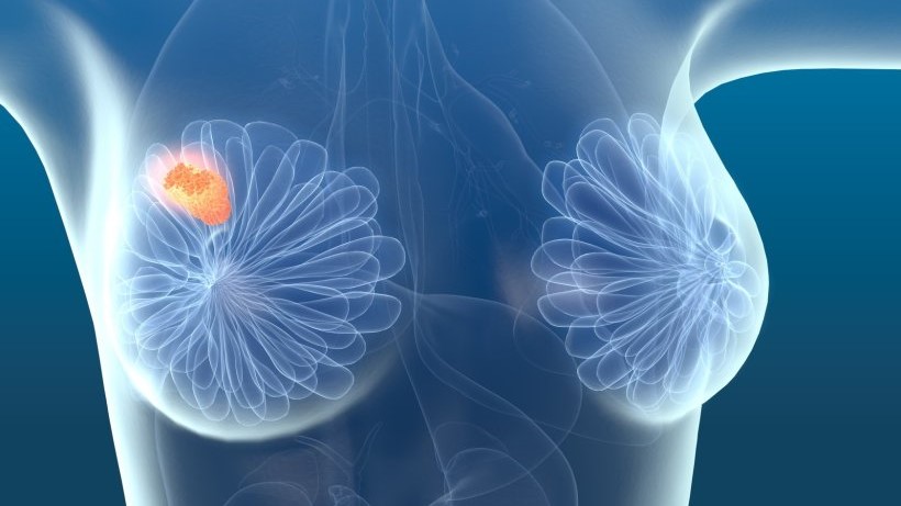 Breast Cancer