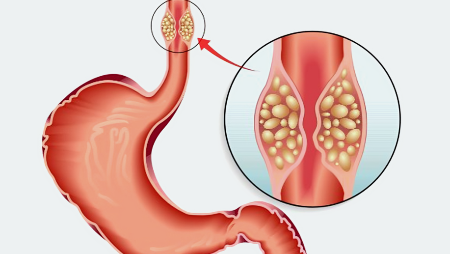 Esophagus Carcinoma