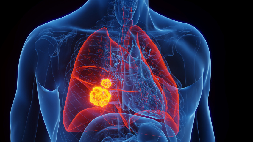 Non-Small Cell Lung Cancer lung cancer deaths