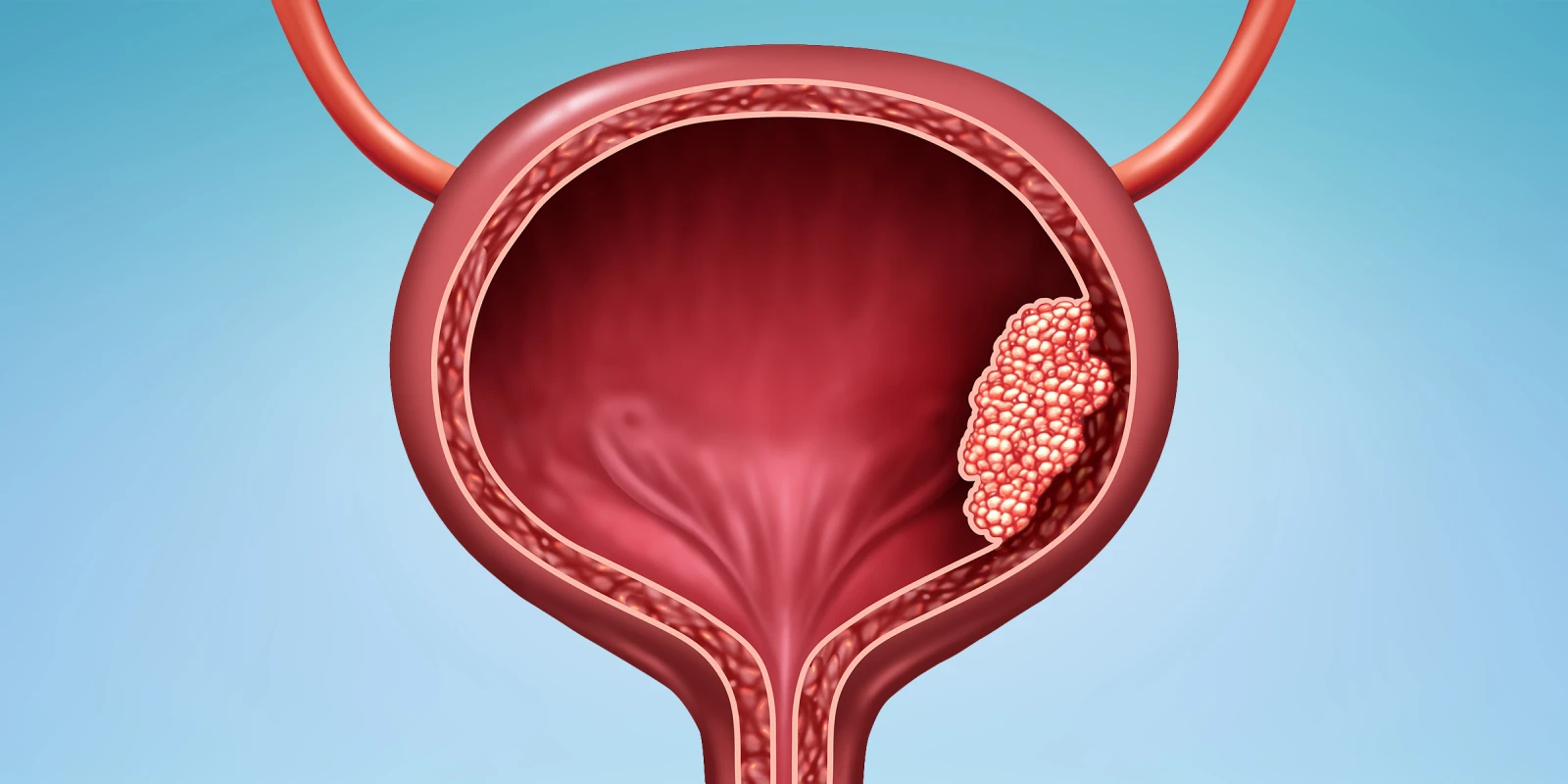 urothelial carcinoma