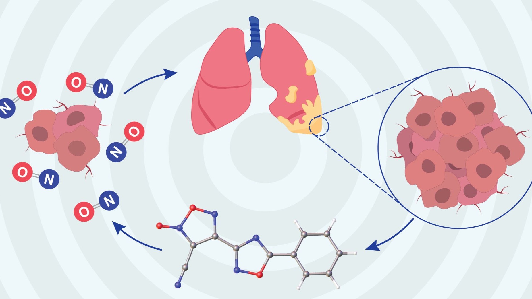 malignant pleural mesothelioma