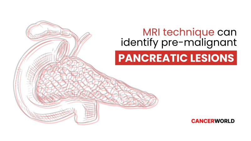 Pancreatic cancer