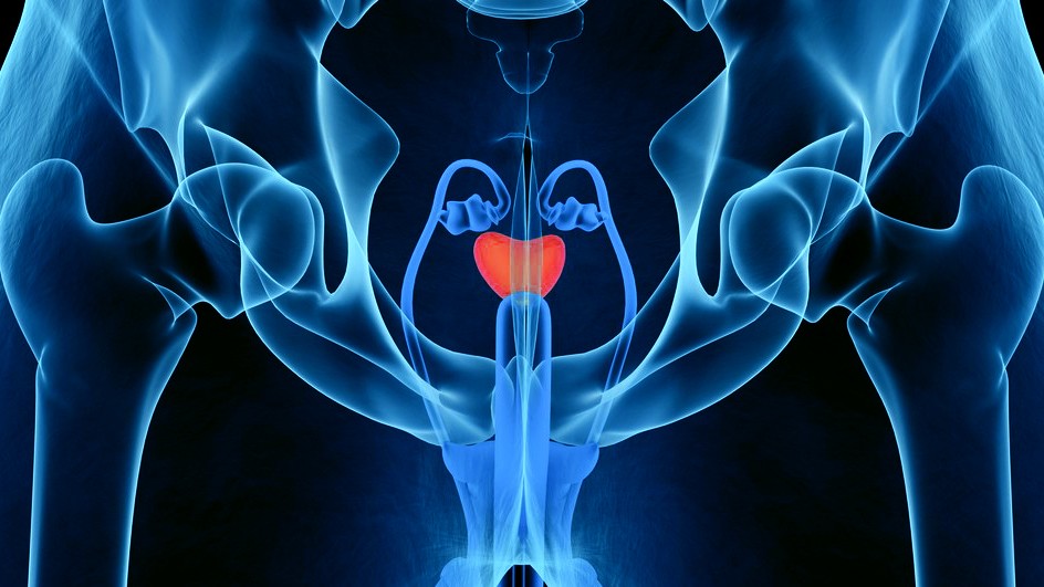 Prostate cancer
