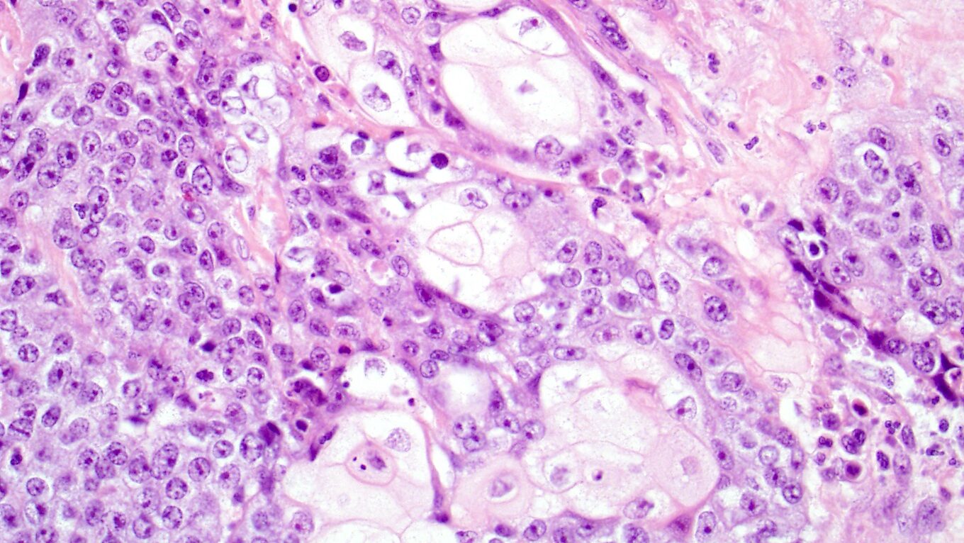 Hiding in plain sight: NUT carcinoma is an unrecognized subtype of squamous cell carcinoma of the lungs and head and neck