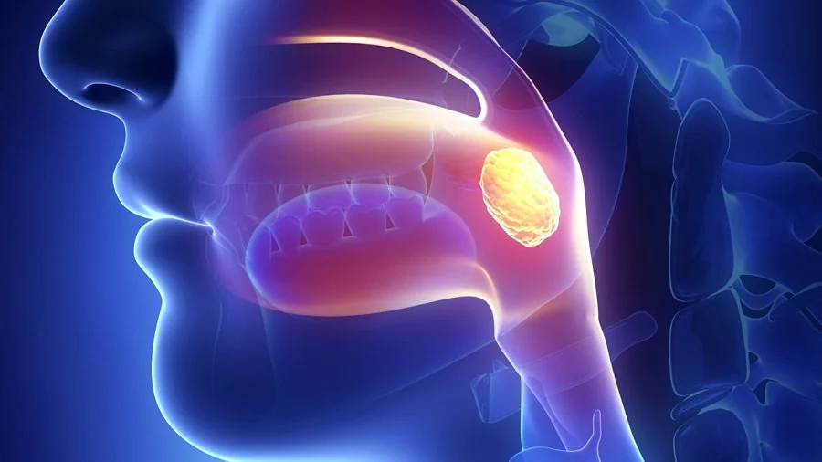 nasopharyngeal carcinoma