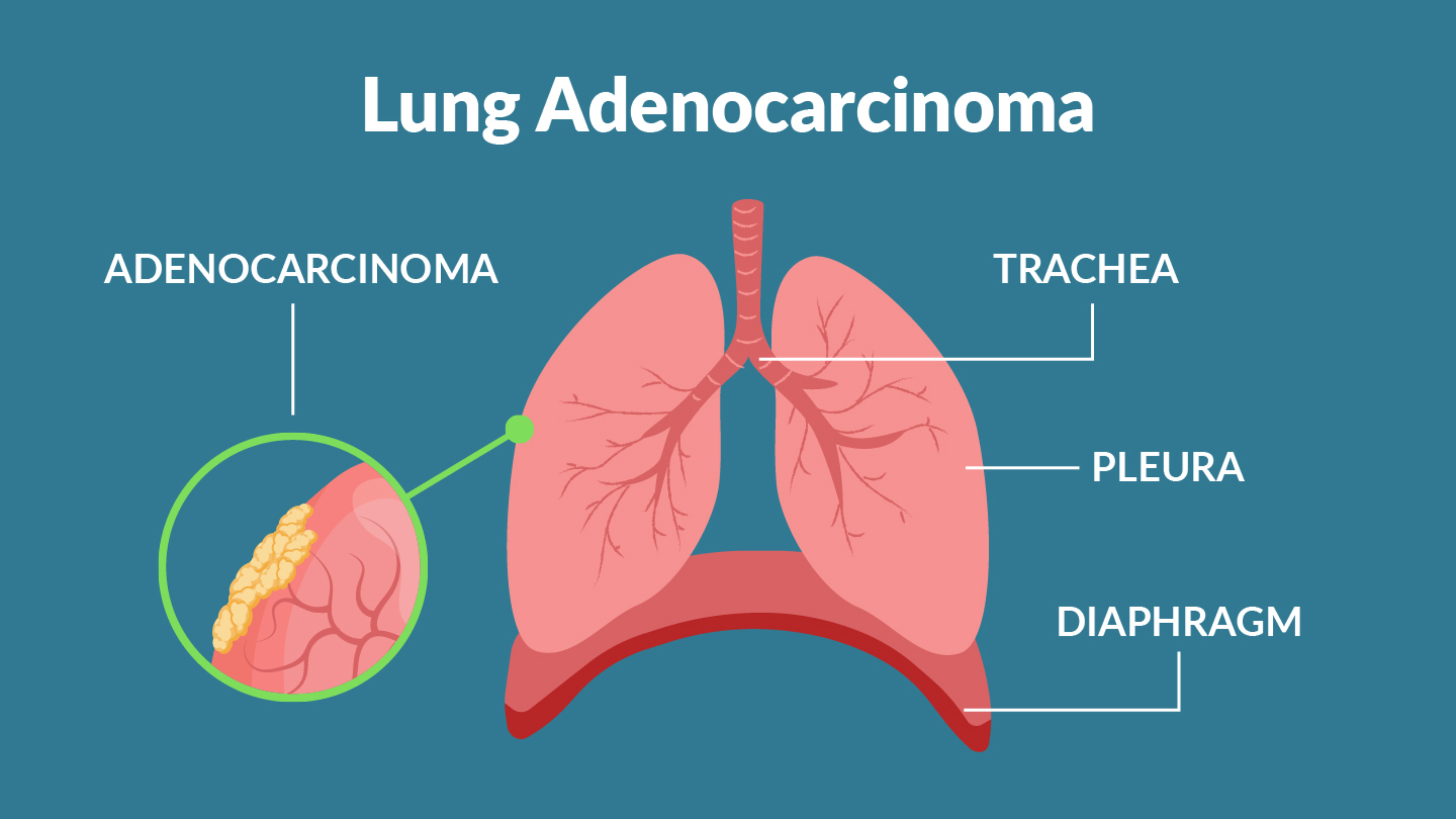 lung adenocarcinomas