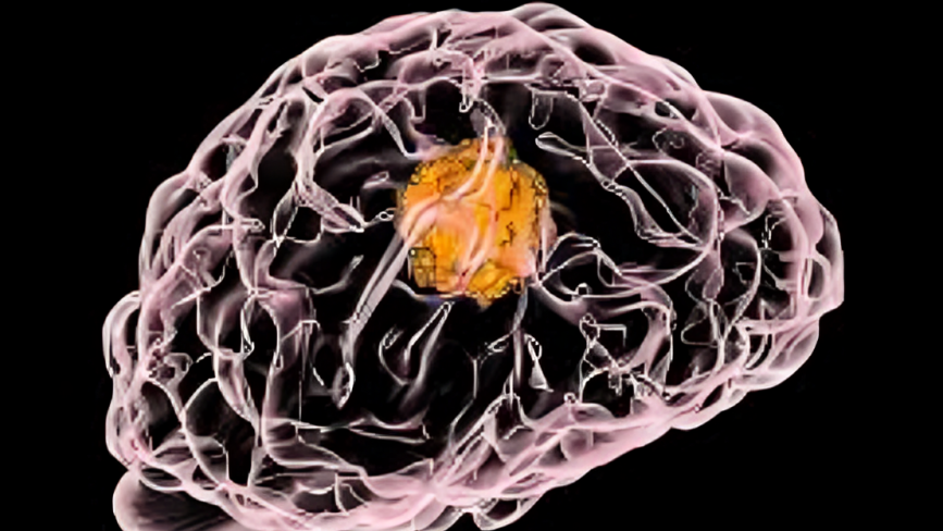 melanoma
