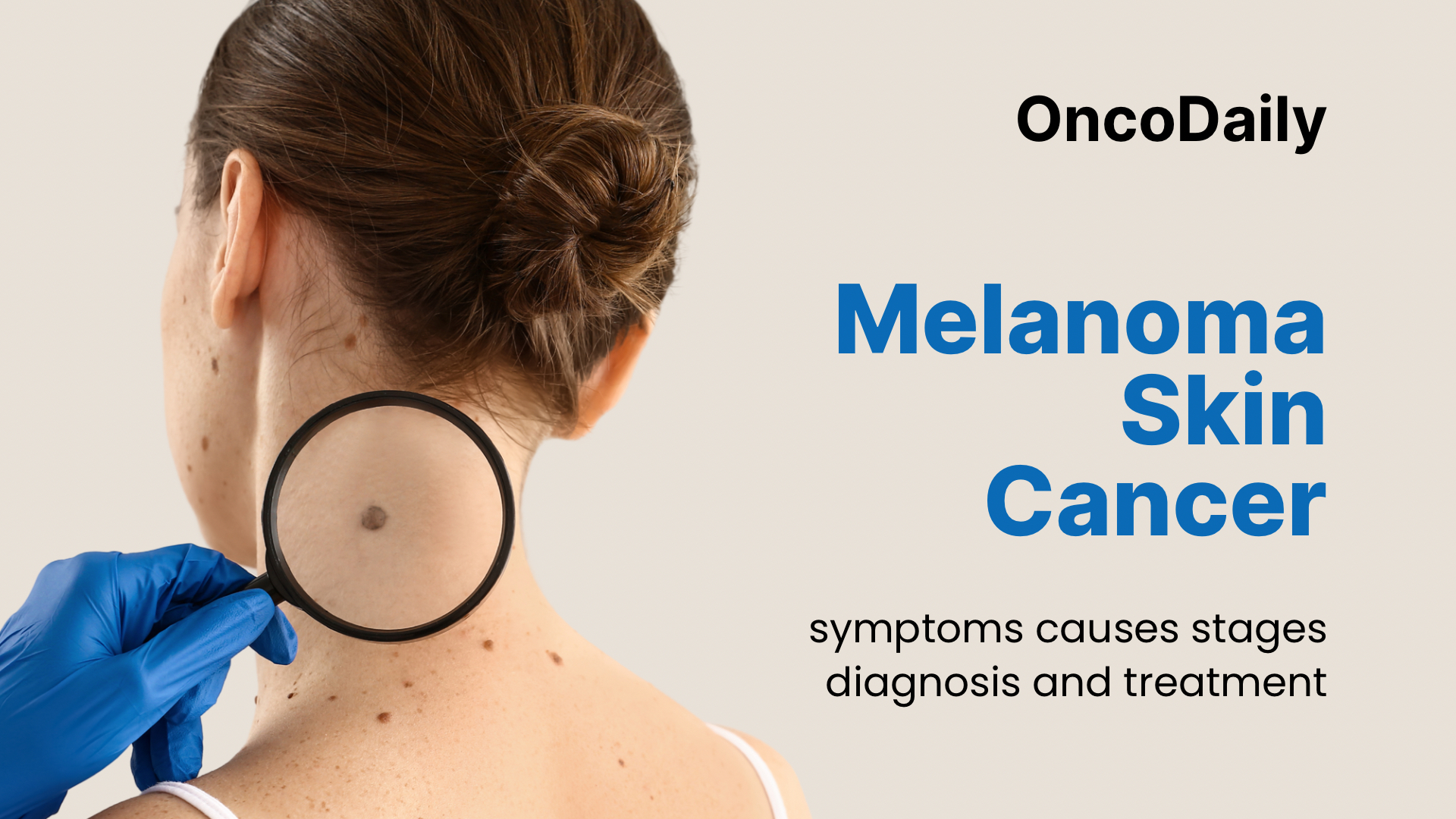 Melanoma OncoDaily