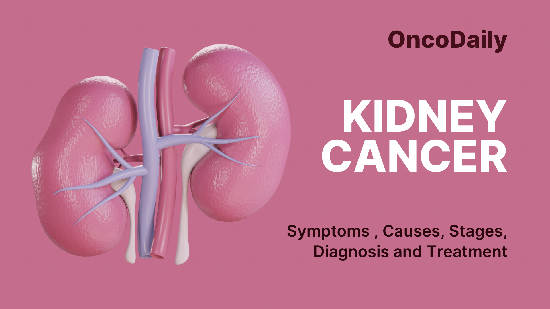 Kidney Cancer: Symptoms ,Causes, Stages, Diagnosis and Treatment