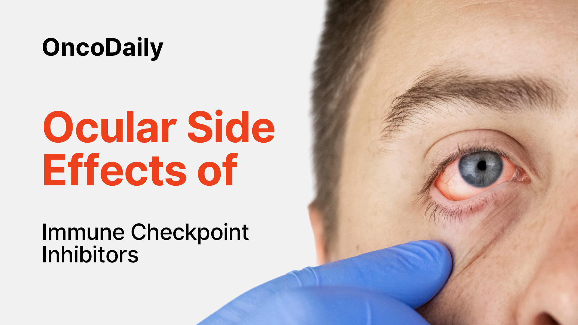 ocular side effects of immune checkpoint inhibitors poster