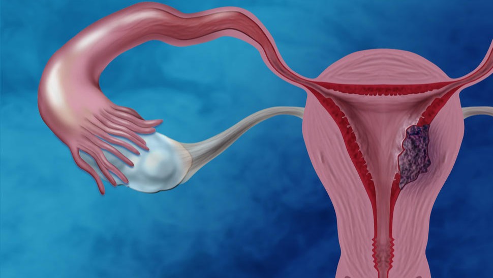 Advanced Endometrial Cancer
