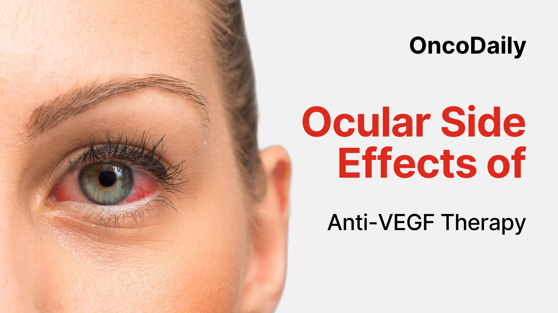ocular side effects of VEGF therapy poster