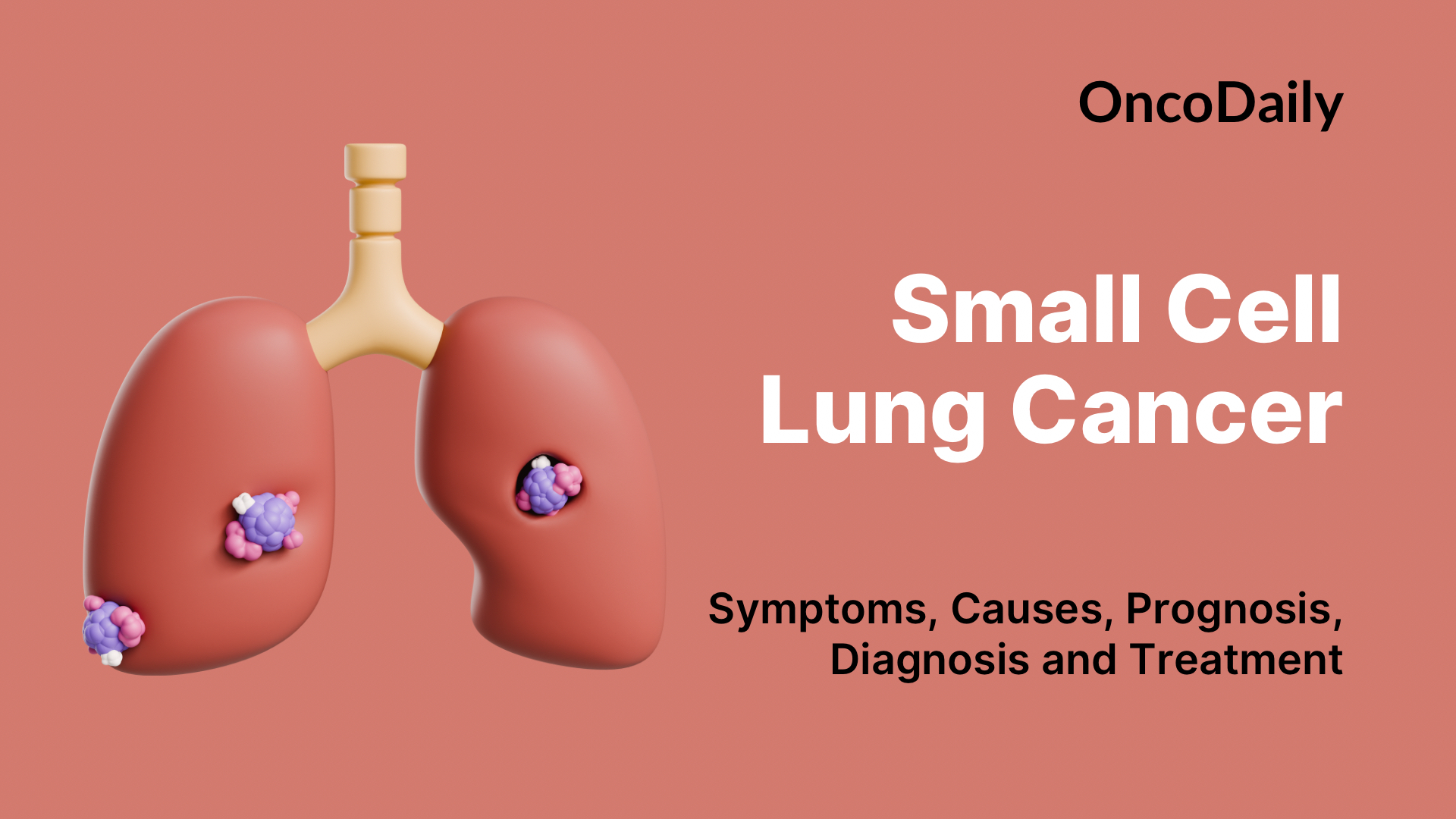 Small Cell Lung Cancer: Symptoms, Causes, Types, Diagnosis and Treatment