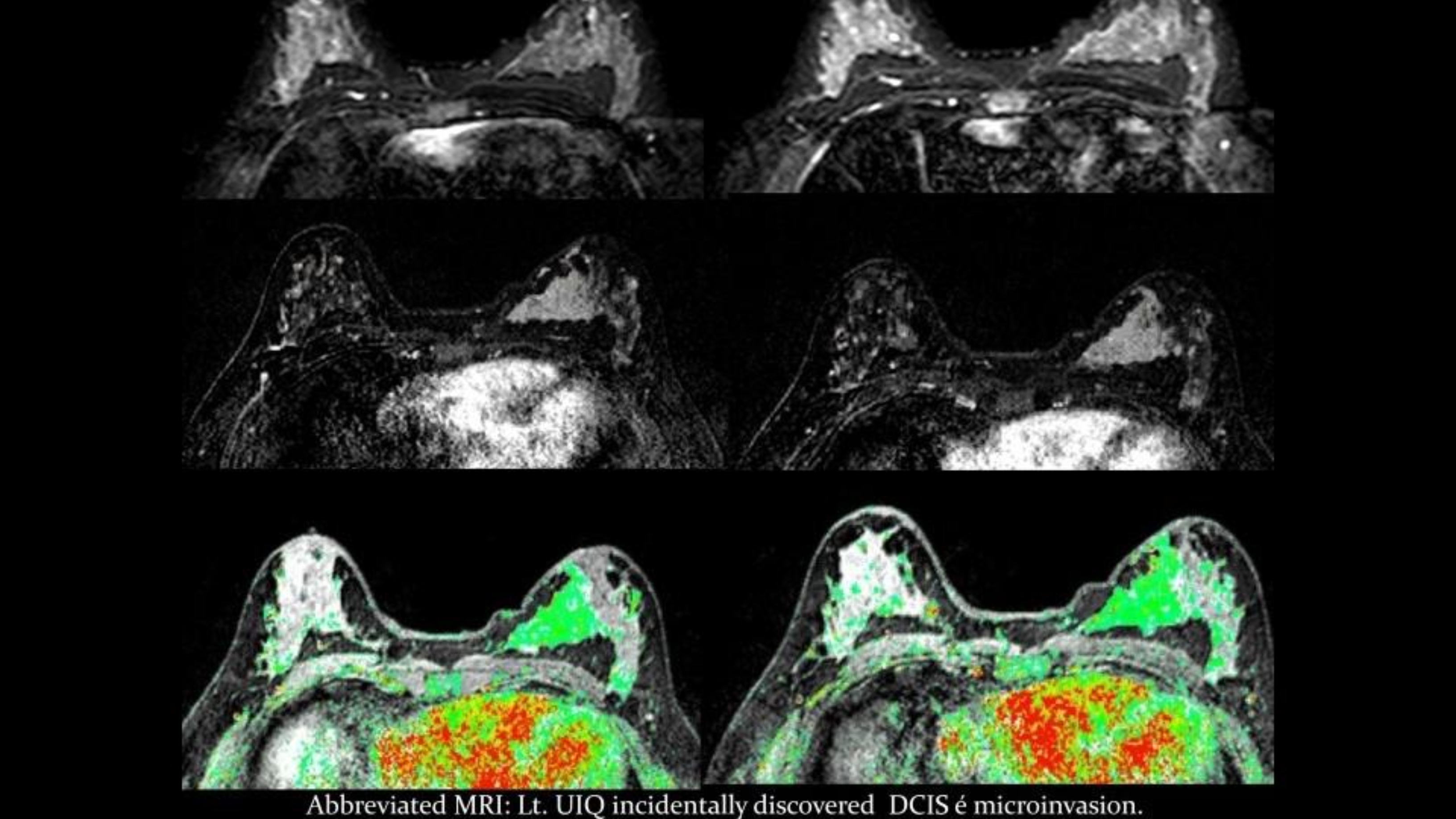 Sahar Mansour: Insights on Abbreviated MRI for Breast Cancer Screening